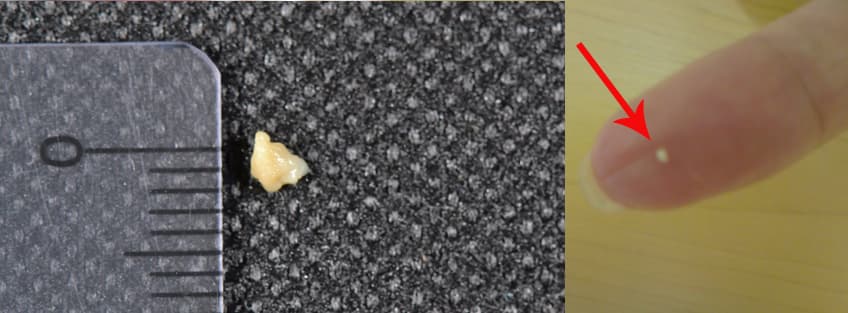 Cáseos amigdalianos nas amígdalas